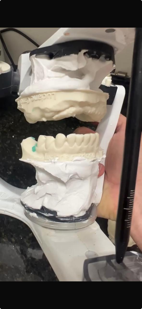 Modelos superior e inferior montados em articulador com gesso, durante montagem em relação cêntrica