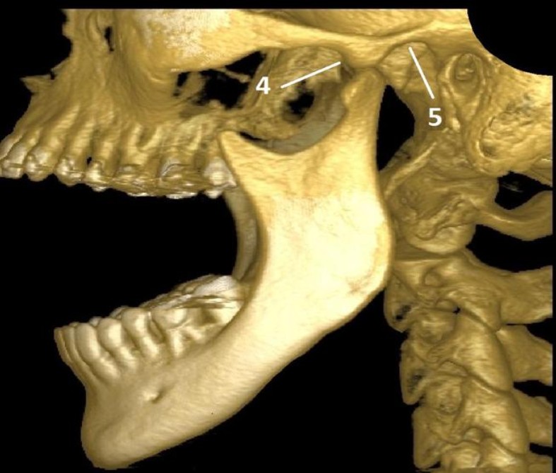 Reconstrução tridimensional de tomografia mostrando o côndilo mandibular, o ramo da mandíbula e a região da articulação temporomandibular em vista lateral